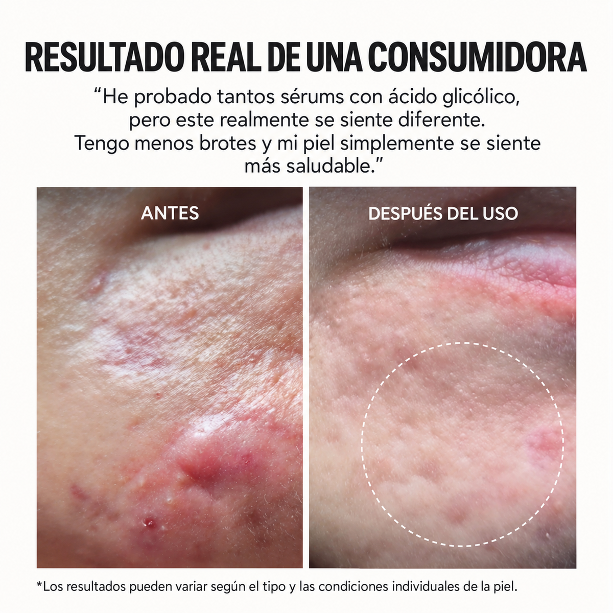 Anua - Azelaic Acid Toner 90 Pads